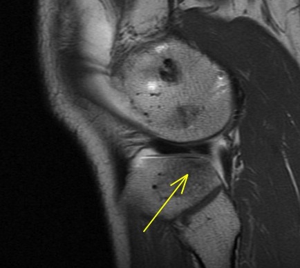 Figure 5 for case Lateral meniscus flap tear and adjacent stress fracture